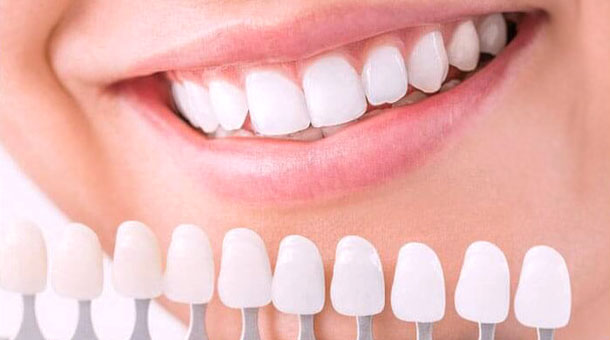 E-max Crowns