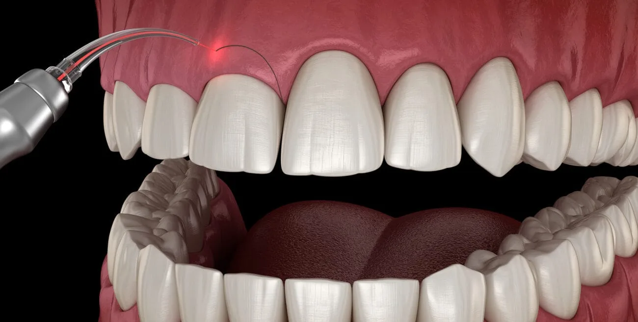 Gum Surgery